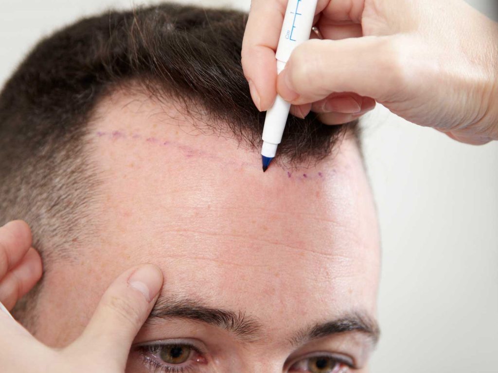 Saç Ekimi ile Doğal ve Kalıcı Çözümler